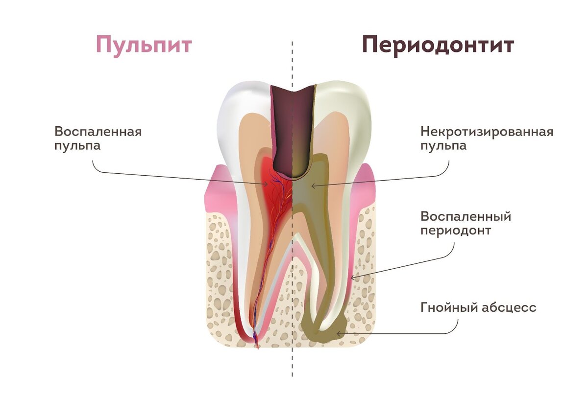 Чем можно приклеить коронки