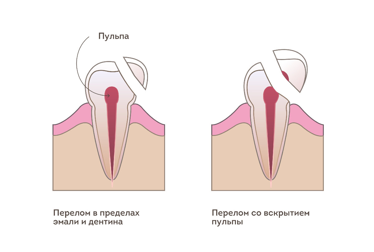 Чем можно приклеить коронки. Отломилась коронка зуба. Откололся зуб что делать.