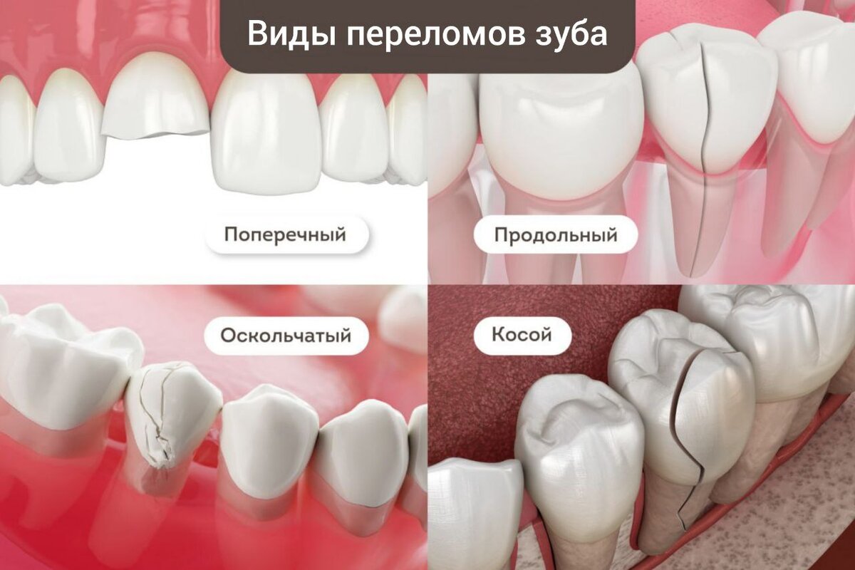 У меня откололся зуб. Что делать? l Стоматология «Профи-Дент» l Новости