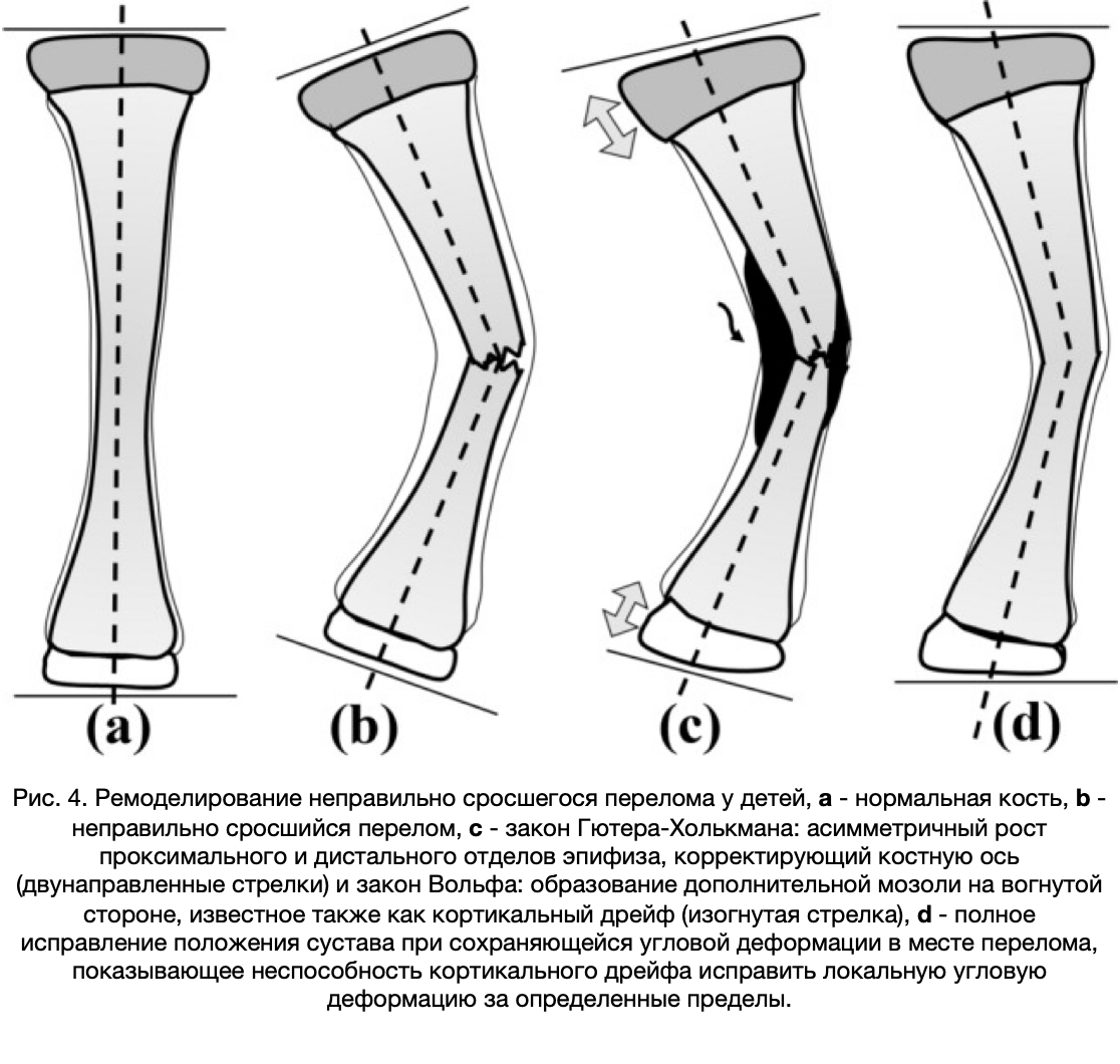 Смещение костей в суставе. Допустимые смещения при переломах у детей. Допустимое смещение при переломе. Что такое перелом с допустимым смещением. Ремоделирование переломов у детей.