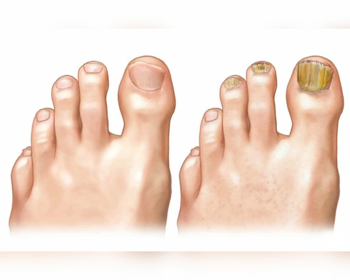 Грибок ногтей и его лечение. 