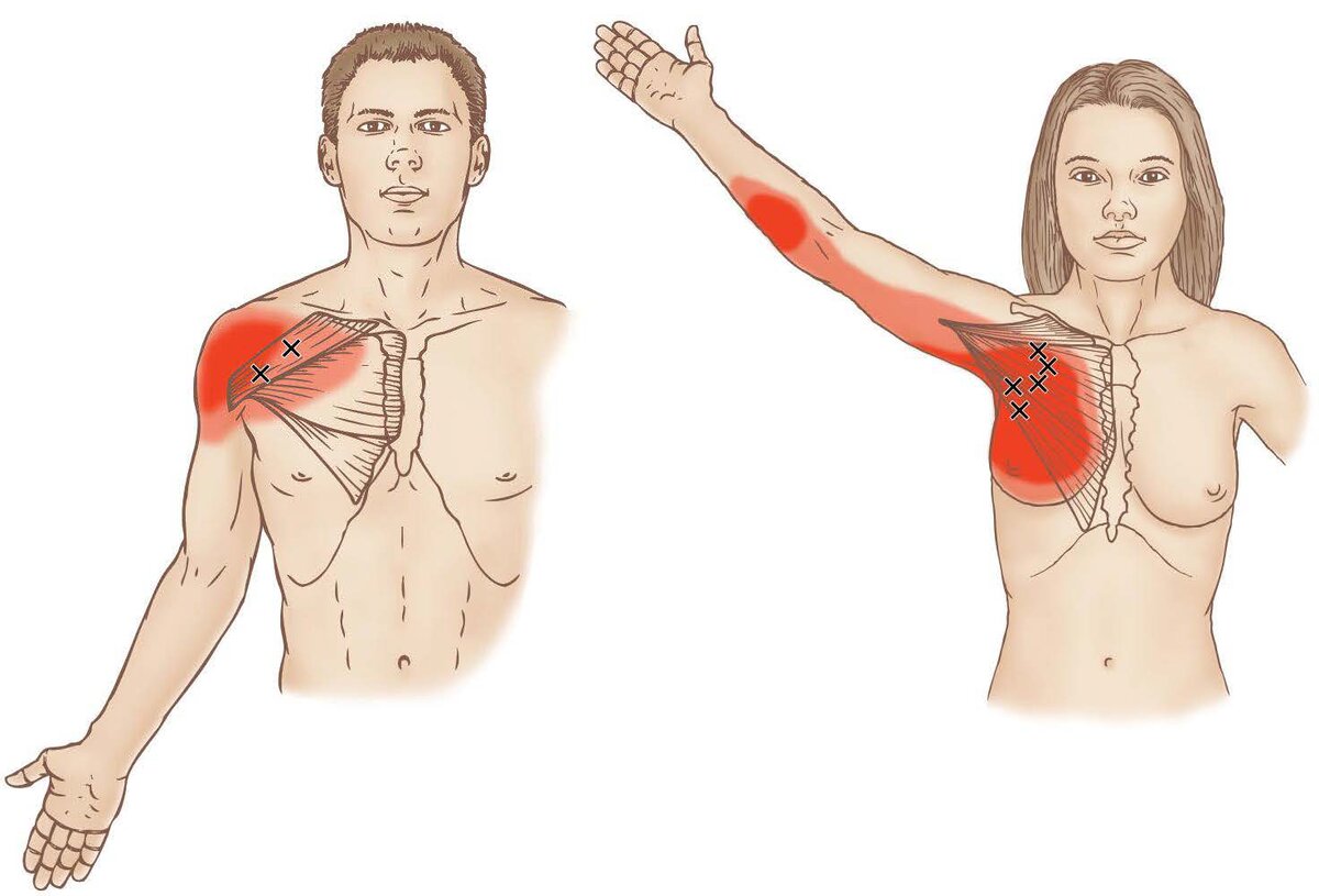 Подключичная мышца триггерные точки