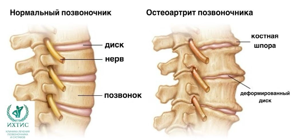 При остеоартрите позвоночника диски сужаются и образуются костные шпоры.