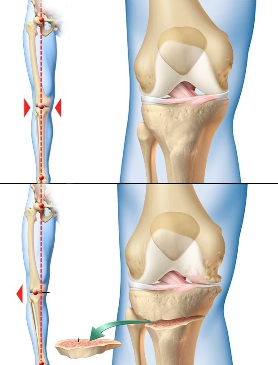 Остеотомия коленного сустава.                                                                                                                              У некоторых людей артрит повреждает одну сторону колена больше, чем другую. Это может привести к изгибу колена внутрь или наружу. Удаление или добавление клина в большеберцовой или бедренной кости может помочь выпрямить искривление и перенести вес тела на неповрежденную часть коленного сустава.