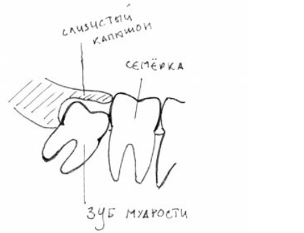 Почему воспаляется капюшон над зубом мудрости? | Стоматология ROOTT | Дзен