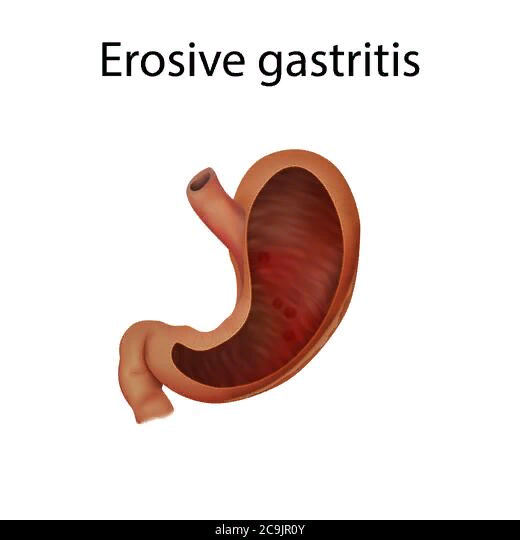 Эрозивный гастрит