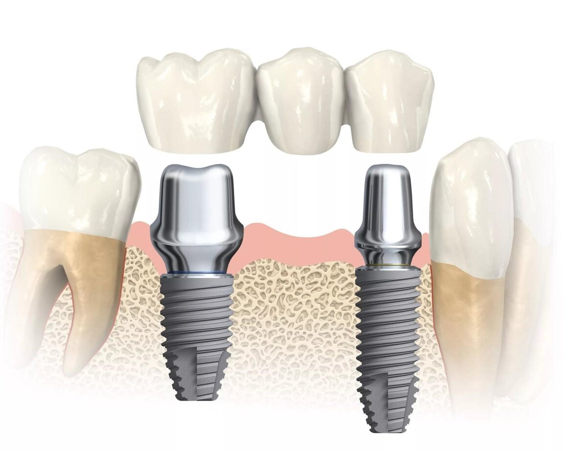 Зубные коронки снятие. Имплантация зубов мостовидные протезы. Имплант зуба Нобель. Имплант абатмент коронка. Имплант Nobel Parallel.