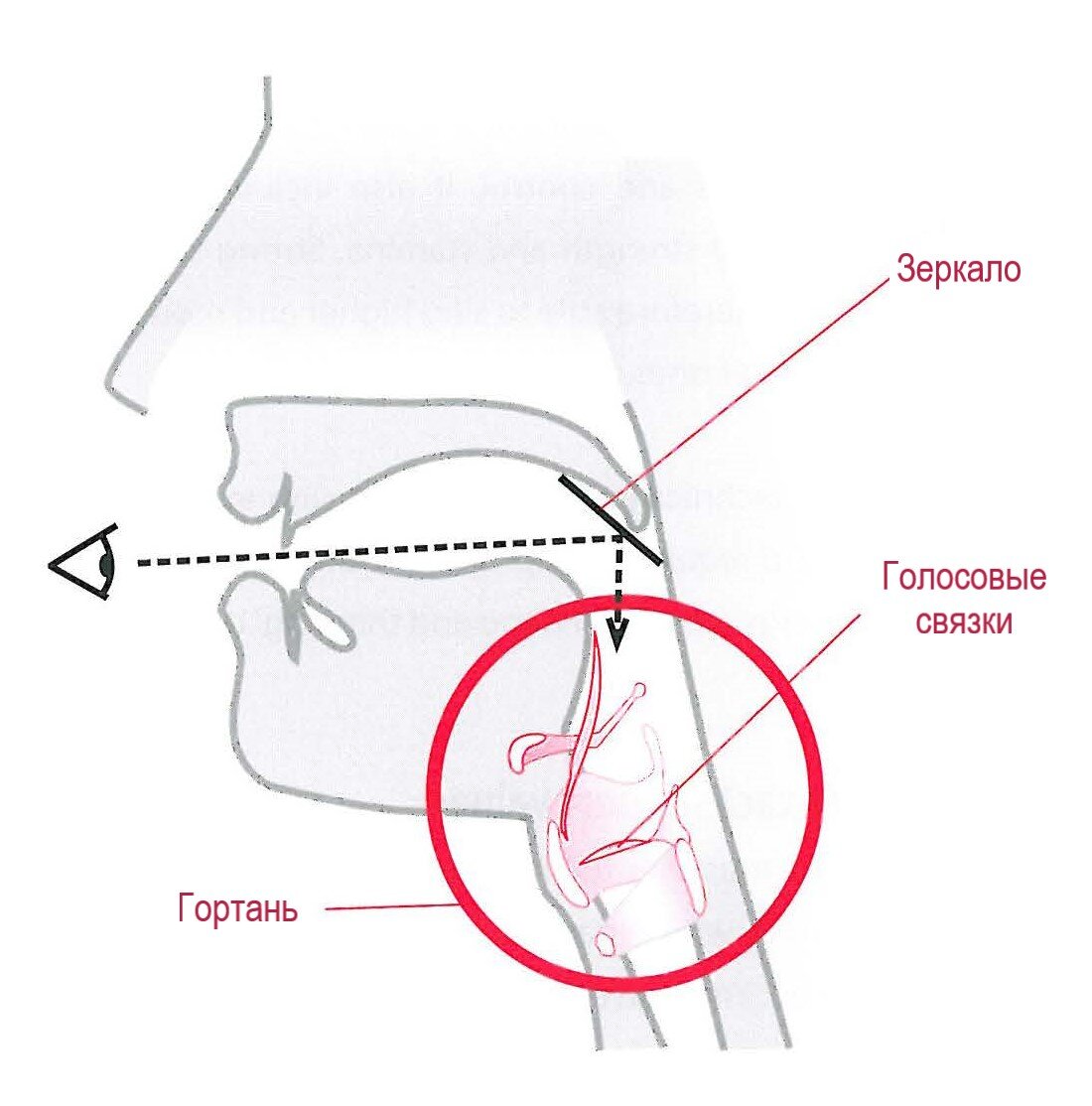 Фиброма гортани