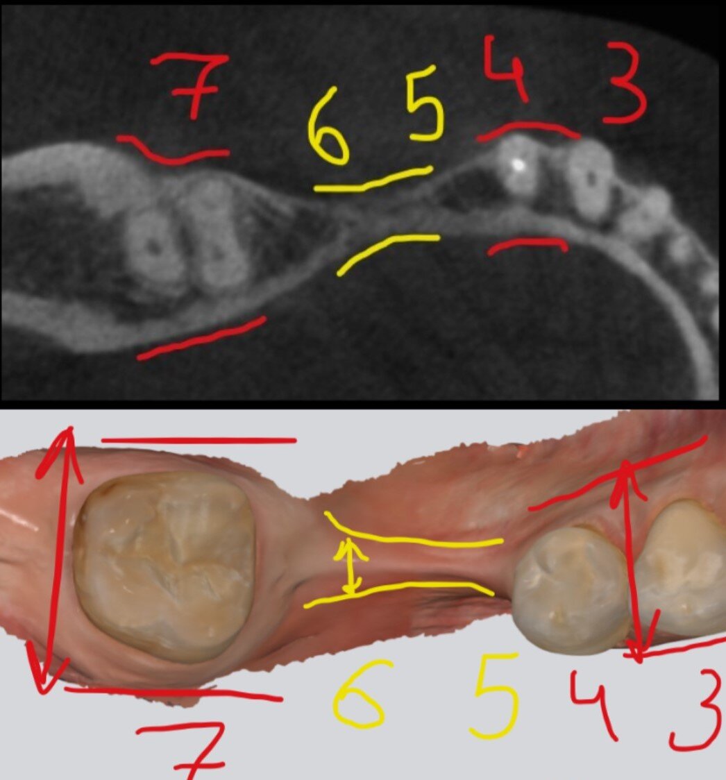 Отсутствующие длительное время зубы - пятёрка и шестёрка