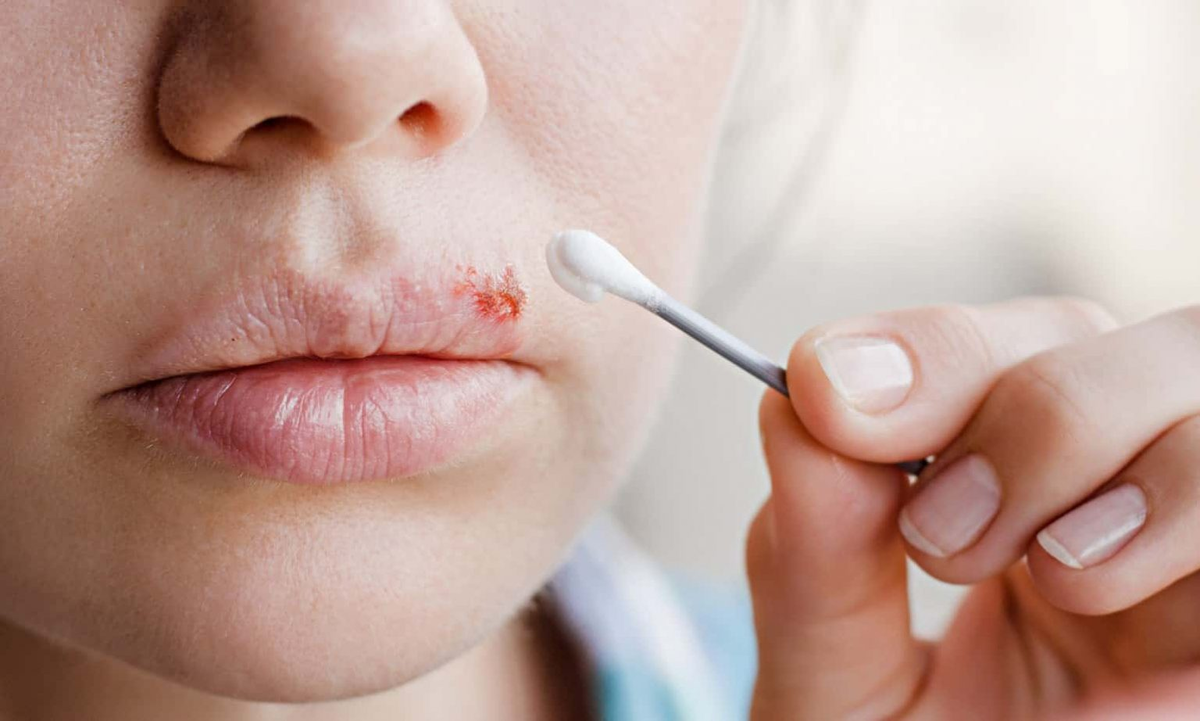 Как спрятать простуду на губах с помощью макияжа — никто даже не догадается!