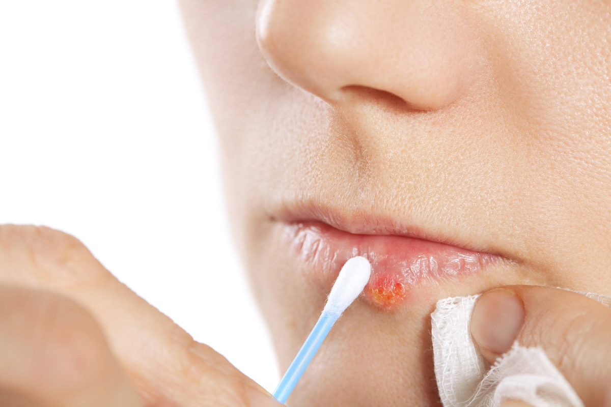 Stylage Special Lips Mepivacaine Bi-SOFT филлер гиалуроновый для увеличения губ 1 мл