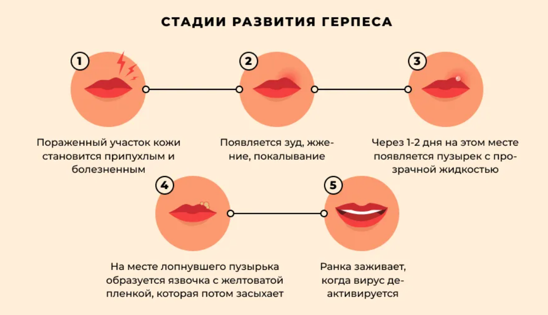 Выскочил Нарост Во Рту - Как Убрать?