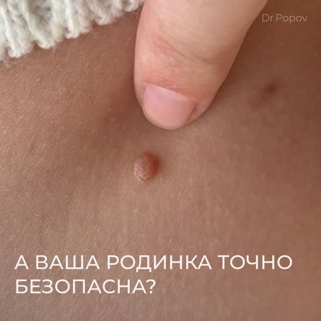 Чтобы быть уверенным в этом, обязательно посетите дерматолога 