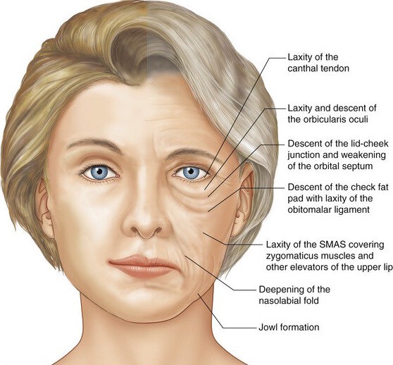 Гравитационный птоз лица 