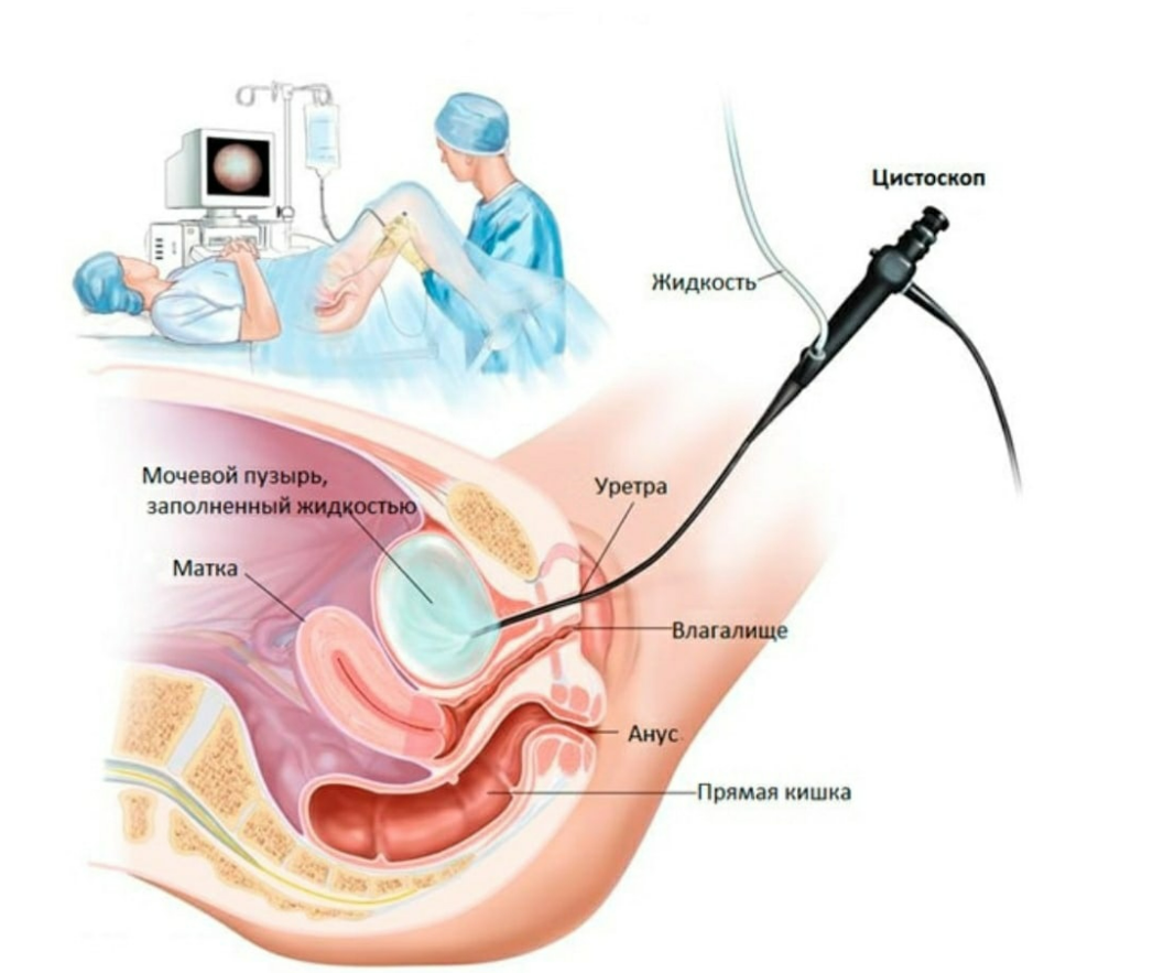 Цистоскопия мочевого пузыря: что помогает обнаружить, как проходит |  Международный медицинский центр «Синай» | Дзен