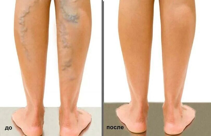 Лечение варикоза. 