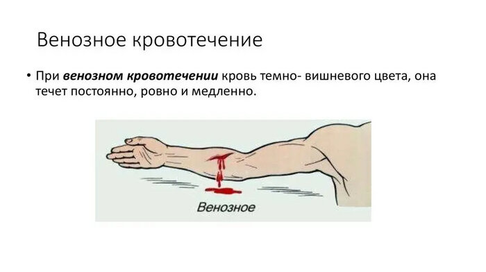 Из приведенных примеров выберите характеризующие венозные кровотечения