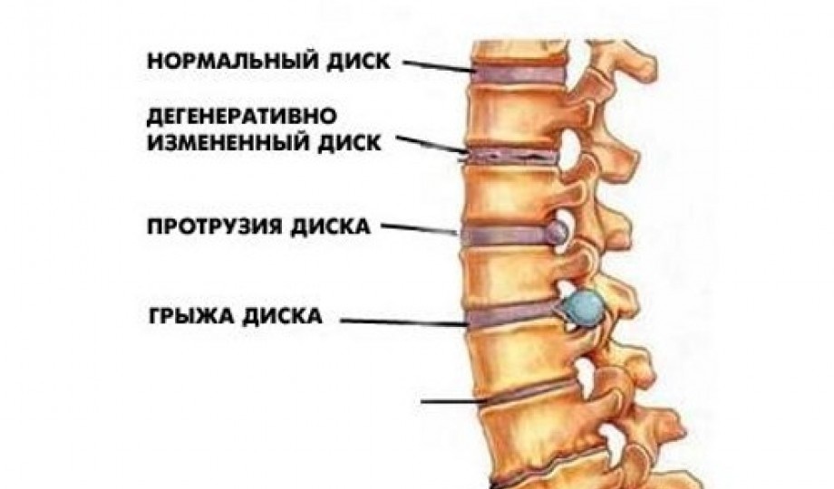 Остеохондроз – это навсегда?
