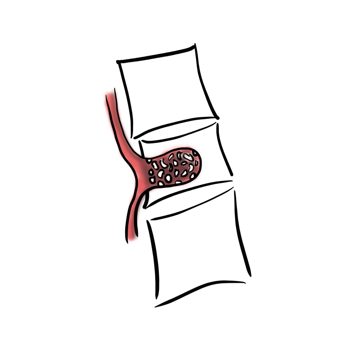 Гемангиома в позвоночнике | Для пациентов | Дзен