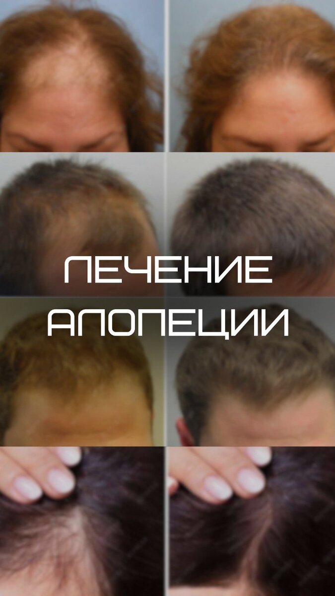 Лечение выпадения волос
