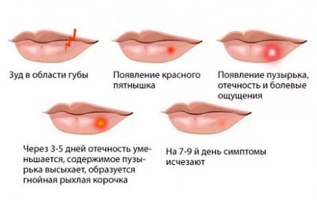 Герпес кожи и слизистых