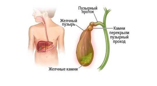 Расширенный желчный пузырь