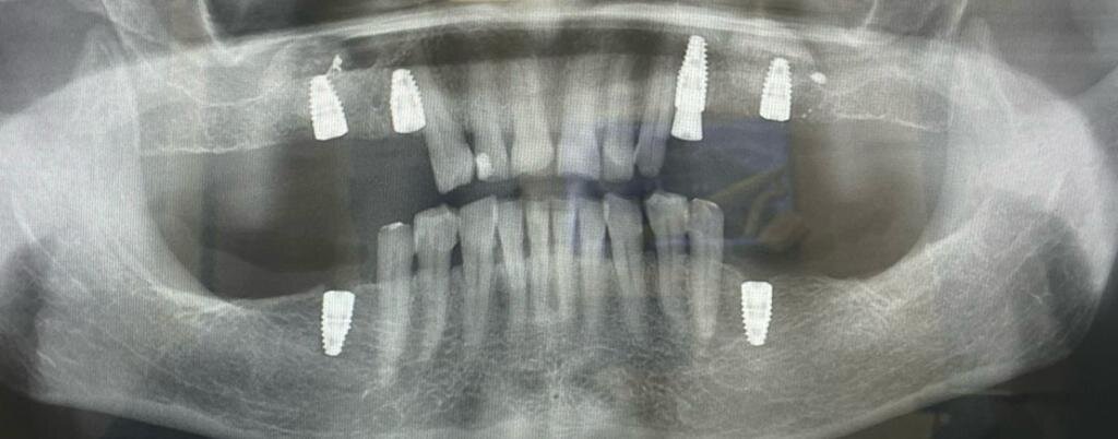 Здесь установлено 6 имплантов. 1 из них довольно-таки близко к зубу, а другой установлен прямо в корень зуба. Запротезировать также здесь не получится грамотно. Не будет десневого сосочка.