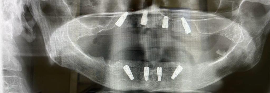 Имплант, что справа на фото, установлен в верхнечелюстную пазуху. В скором времени это приведет к воспалительному процессу и отторжению импланта.