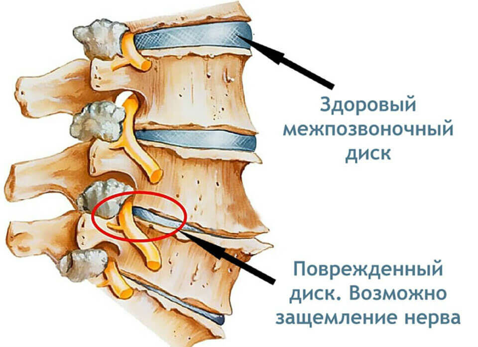 Позвоночник человека грыжа