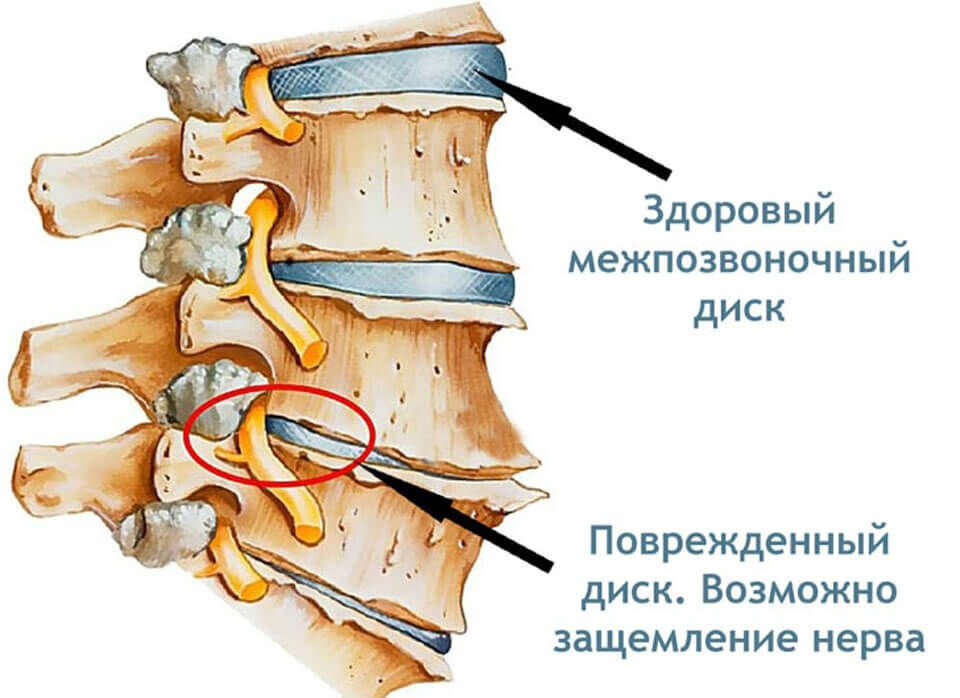 Восстановление формы и функции межпозвонкового диска. Повреждение межпозвоночных дисков поясничного отдела. Защемление позвонка l5-s1. Защемление корешкового нерва. Межпозвоночный диск.