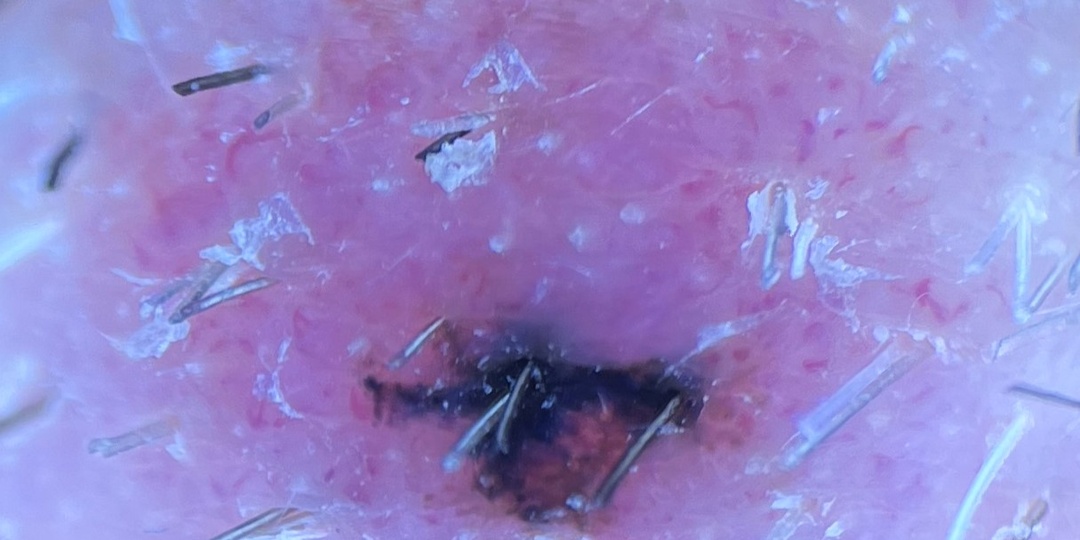 Меланома или диспластический невус?