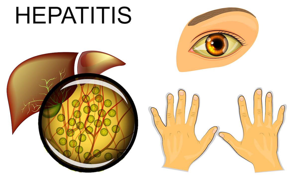Гепатит а рисунки