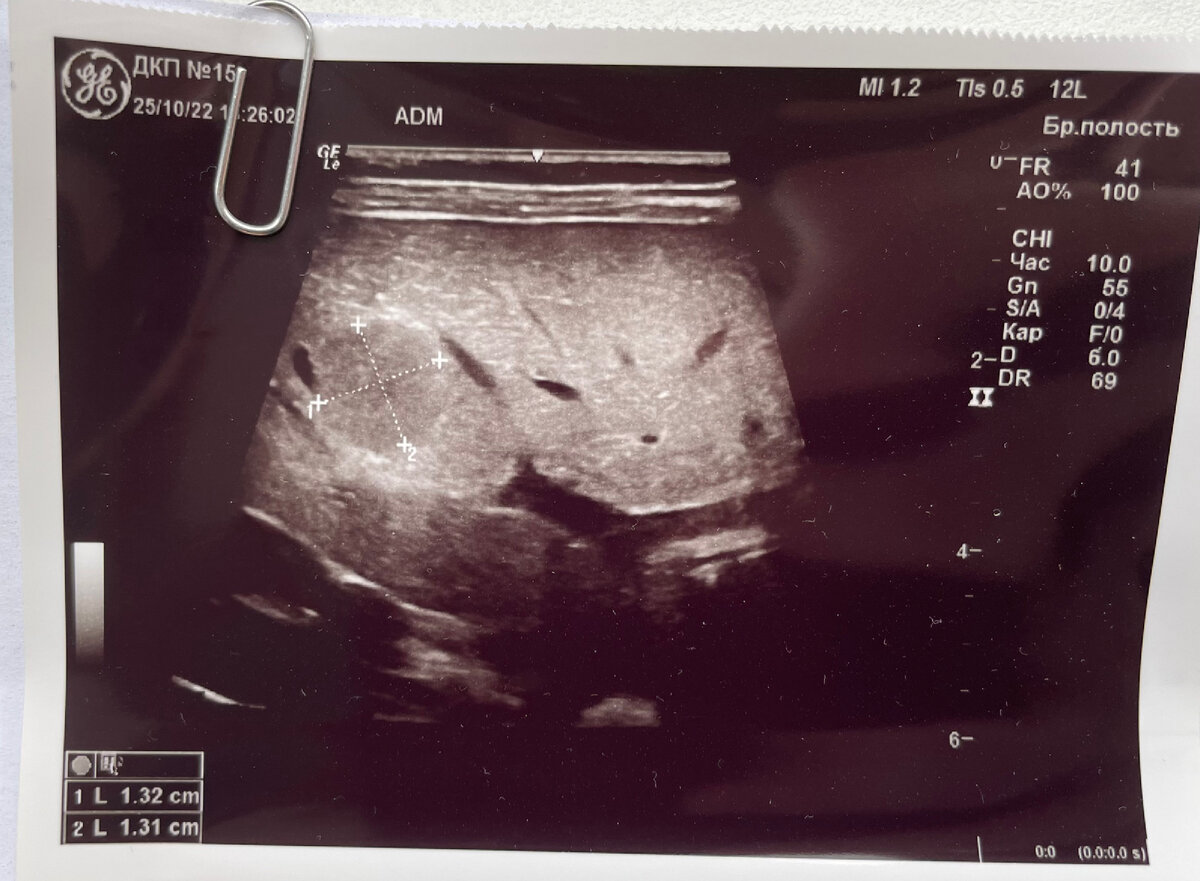 Тот самый снимок узи