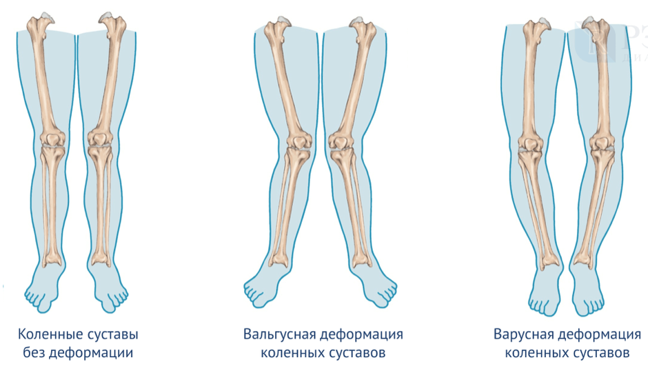 Соответственно, в центре Х-образные ноги, справа - О-образные