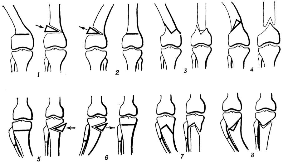 Старенькая схемка остеотомий, сейчас вариантов еще больше