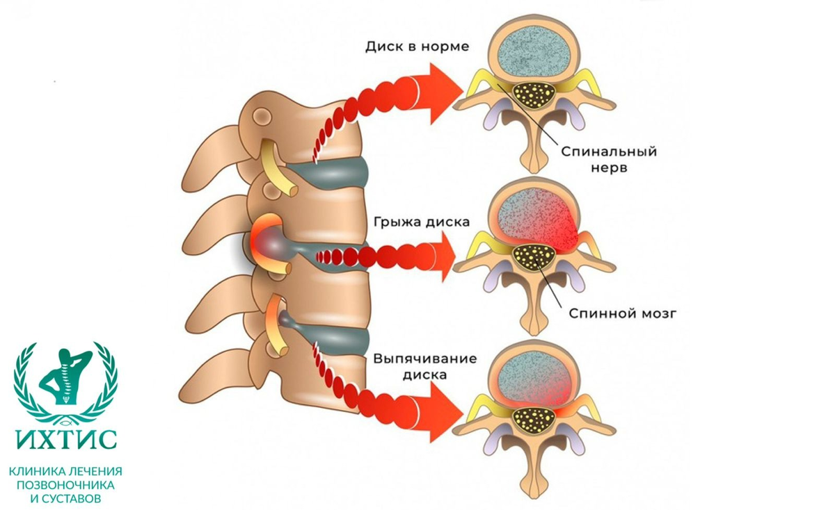 Грыжа межпозвонкового диска – это состояние, при котором студенистое ядро ​​смещается из межпозвонкового пространства. Это частая причина болей в спине.-2