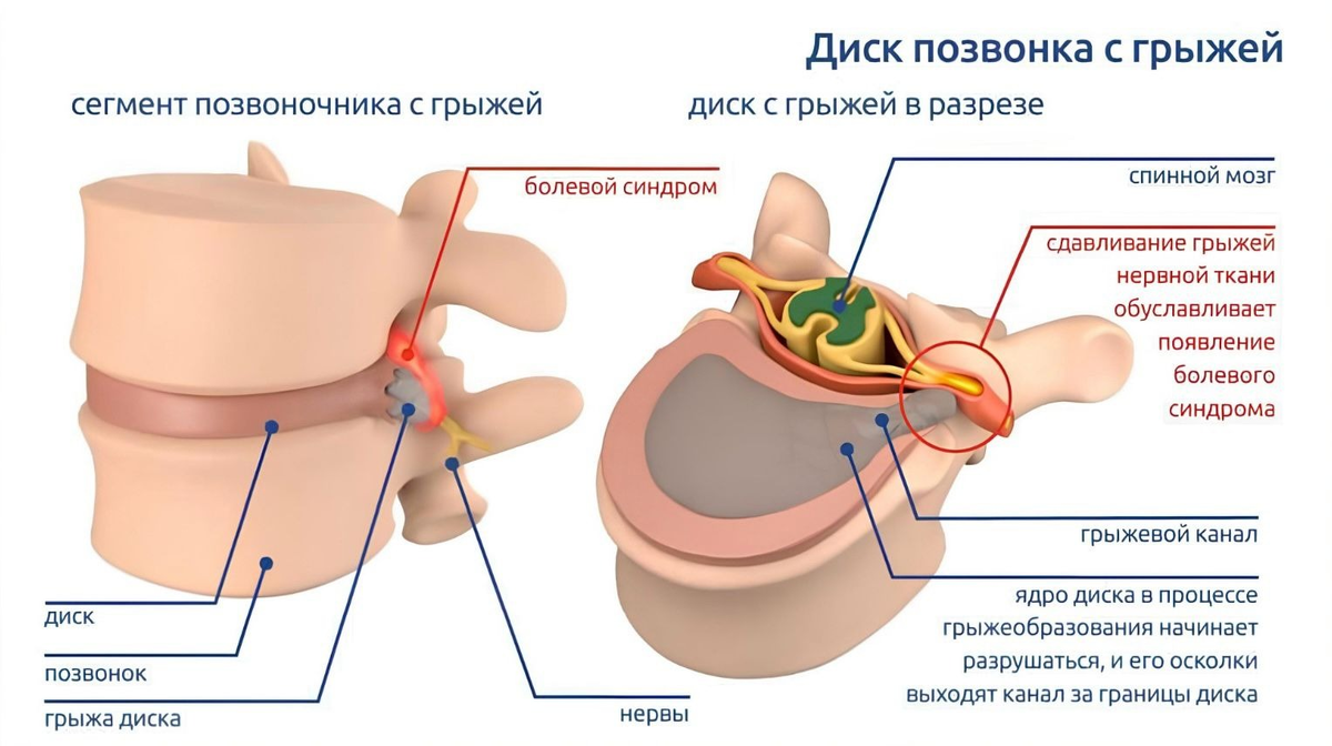 Высота межпозвоночного диска