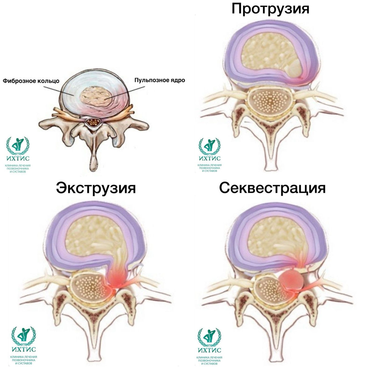 Грыжа межпозвонкового диска – это состояние, при котором студенистое ядро ​​смещается из межпозвонкового пространства. Это частая причина болей в спине.-5
