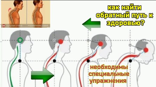 Хотите спасти шею, улучшить работу мозга, исправить осанку? Освободите от компрессии подключичные артерии