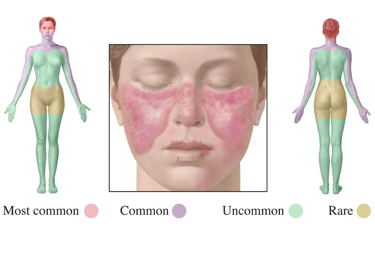Признаки красной волчанки у женщин фото
