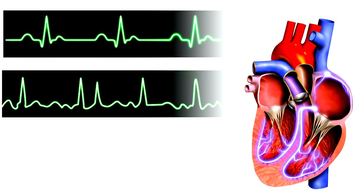 Если вам определили аритмию: вариант патологии, можно ли подобрать ...