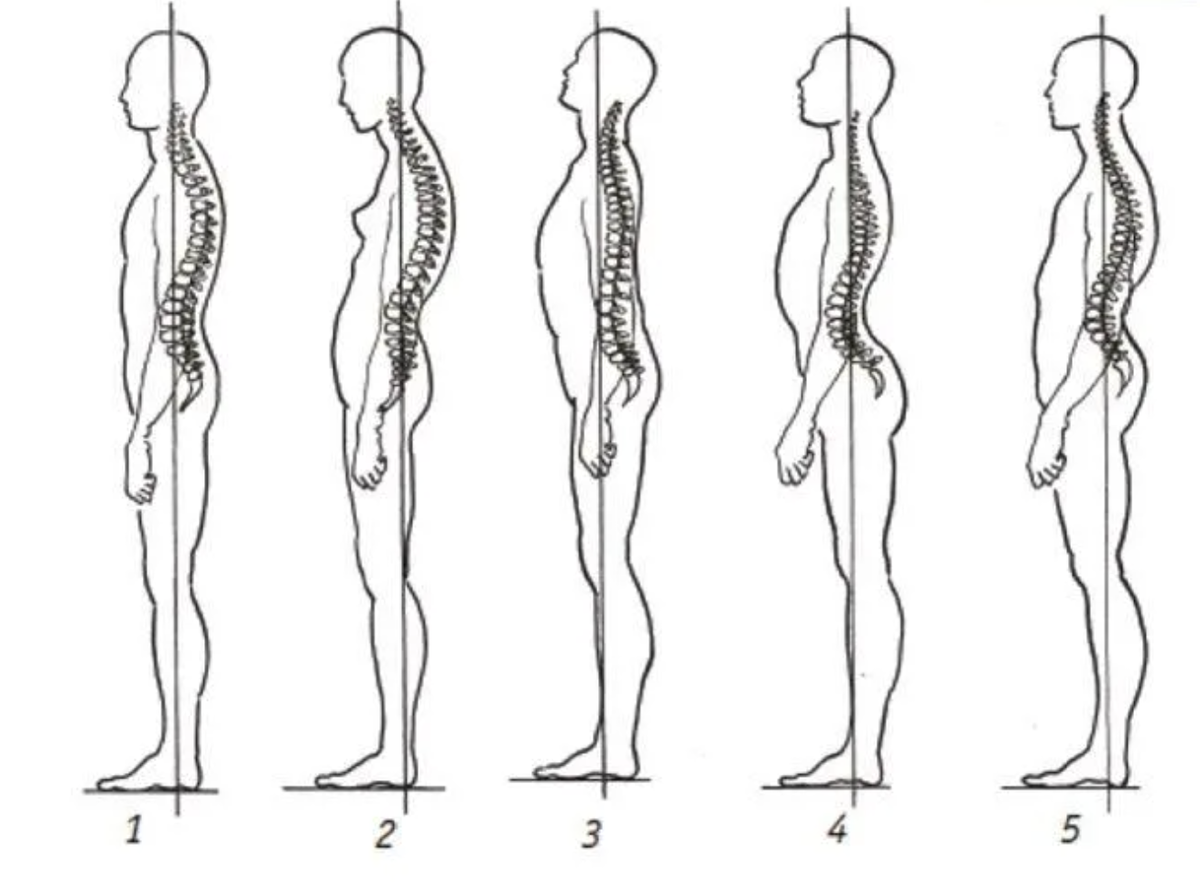 Типы осанки человека по штаффелю. Норма осанки скелет. Сколиоз позвоночника таза. Скелет человека с правильной осанкой.