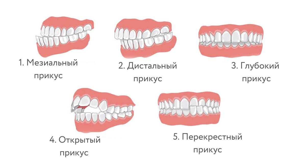 Правильный прикус у человека фото схема