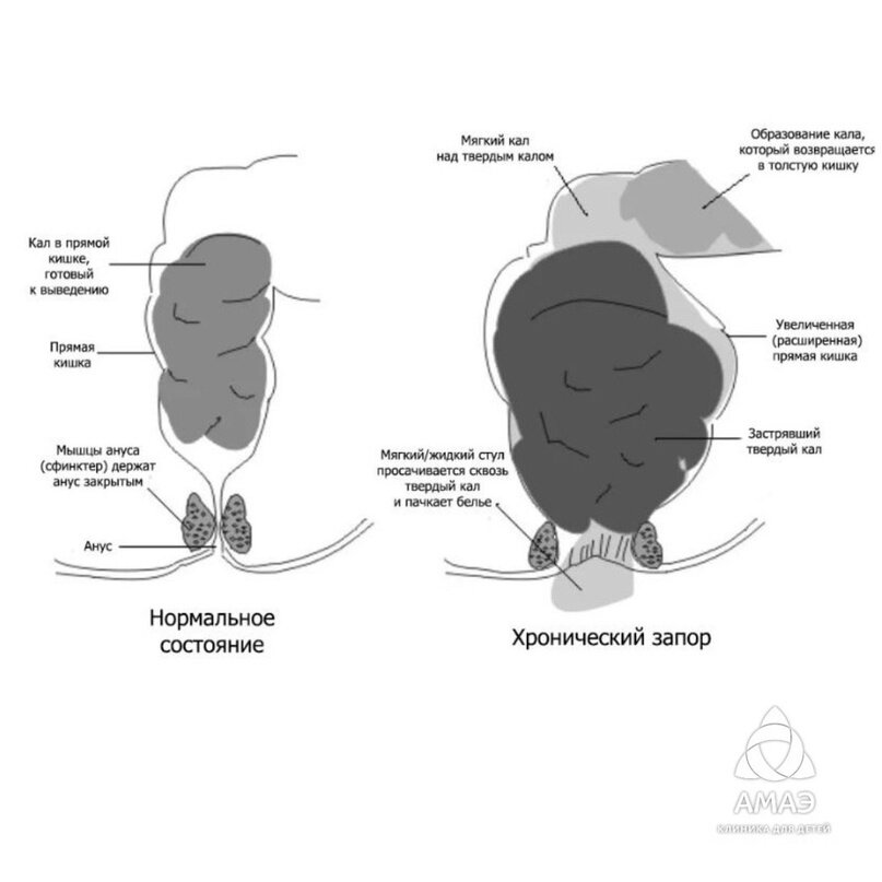 Запор у ребенка