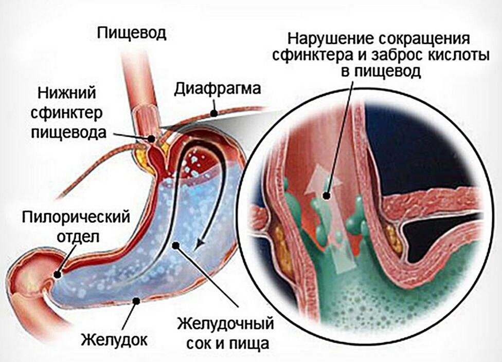 Желудок кислота во рту