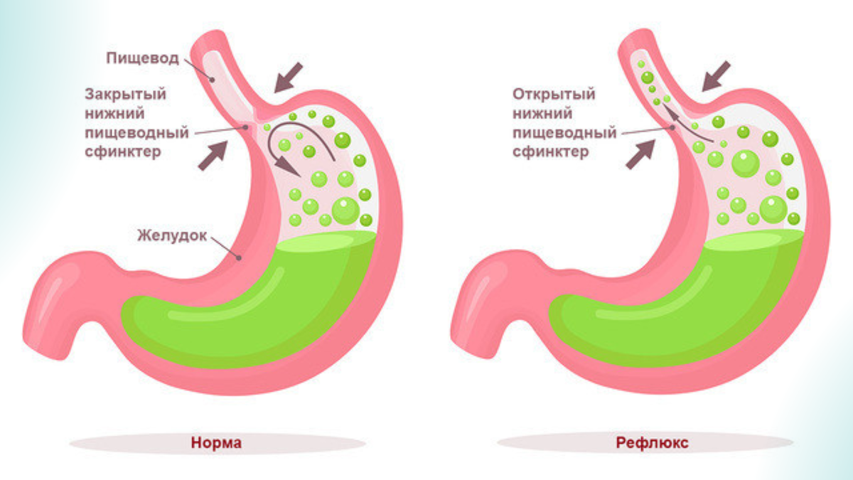 Гастроэзофагеальная рефлюксная болезнь. Желудок инфографика.