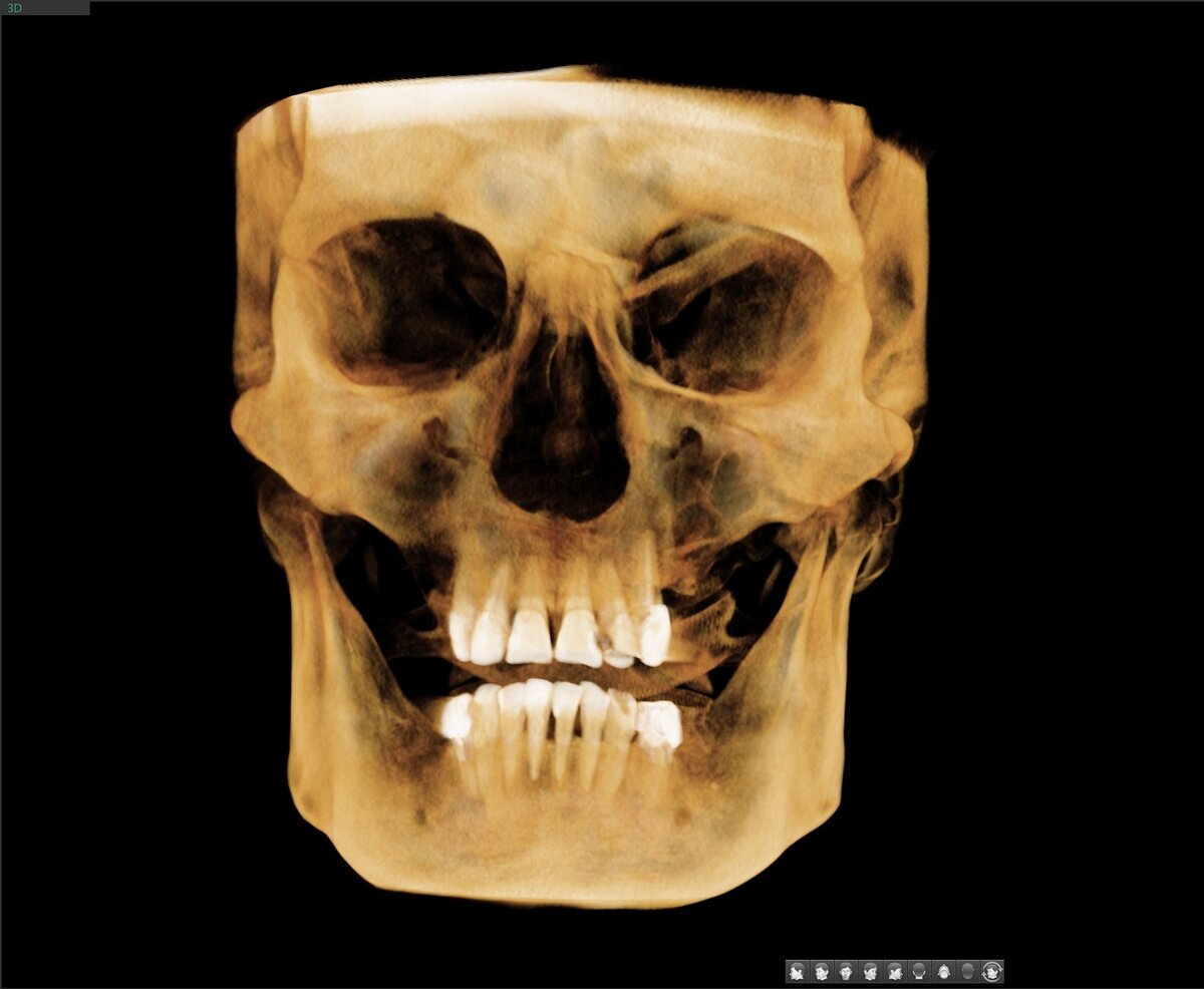 3Д визуализация костей черепа и зубов.