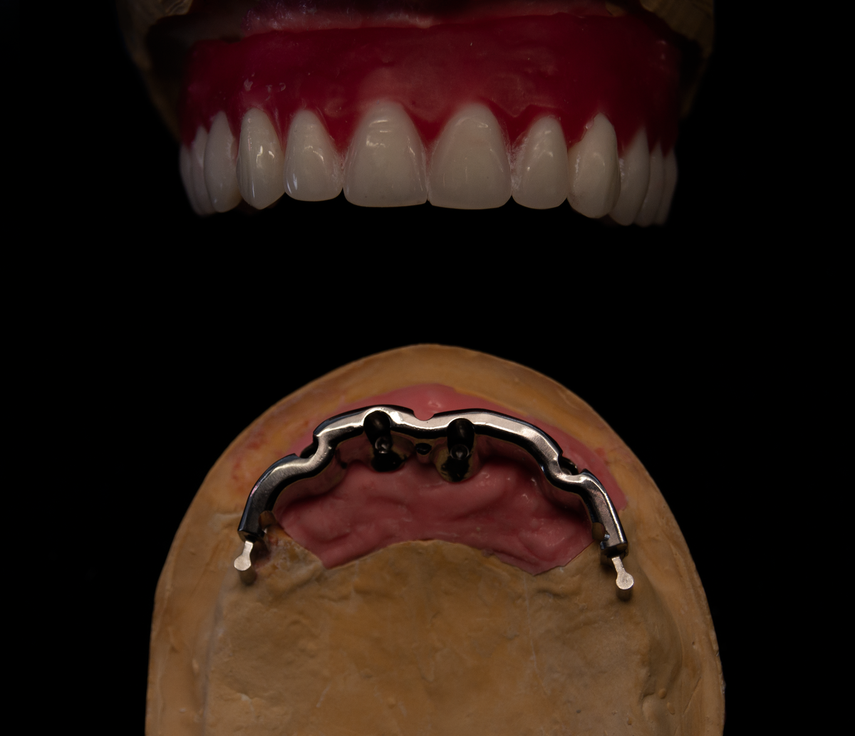 Балка с замками, и диагностическая постановка.