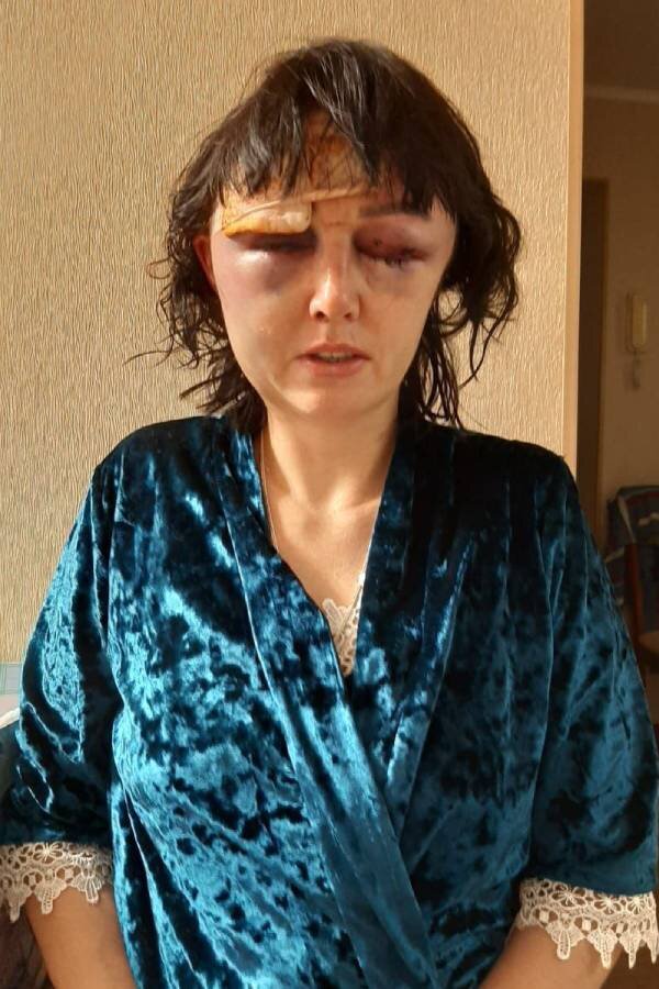 Фото Веры после избиения. https://takiedela.ru/notes/vera-iz-buzuluka/