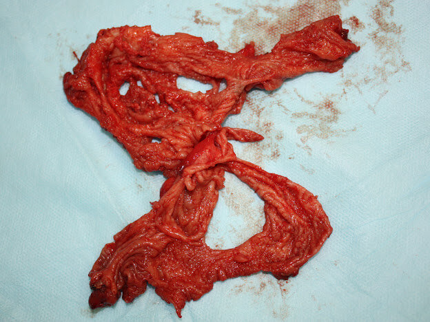 Поврежденные гелем ткани